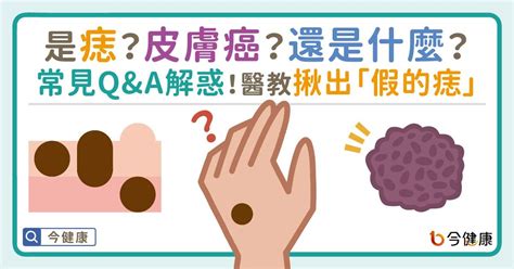 胸部紅色痣|是痣or皮膚癌？醫「1張圖秒對照」 長這2部位最危險